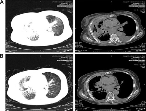 Figure 1 Patient I: Computed tomography shows the mass in the right lung with left lung metastasis and pleural effusion (A) before apatinib treatment and (B) after apatinib treatment was given for 2 weeks.