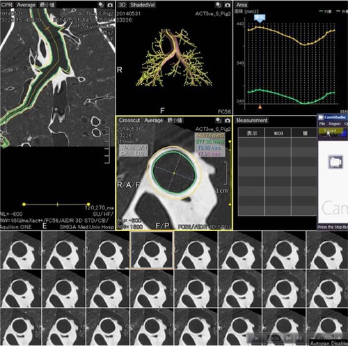 Figure 4 A sample image for the quantitative tracheal measurement provided by the software.