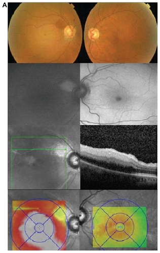 Figure 2a Color fundus photographs of the right eye (Case 2) showing central retinal artery occlusion with cilioretinal sparing and normal left eye. The decreased autofluorescence of the right eye correspond to marked inner retinal thickening on HD-OCT, with normal autofluorescence in the cilioretinal area. The thickening of the retina is obvious in the retinal thickness color map as well.