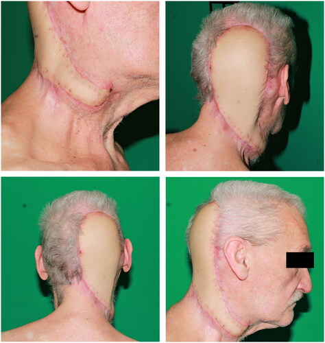 Figure 5. Postoperative result five weeks after defect coverage with a free myocutaneous latissimus dorsi flap.