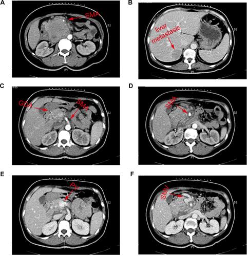 Figure 1 The result of CT-abdomen on March 11, 2019. (A) The invasion of SMA; (B) the metastasis of right liver; (C) the invasion of GDA and SMA; (D) the invasion of SMA; (E) the invasion of PV; (F) the invasion of SMV.