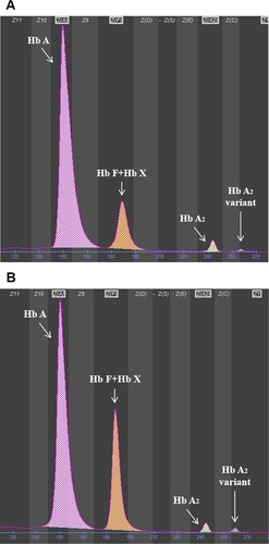 Figure 1. Hemoglobin analysis by using CE. (A) Similar results for the two patients in the present study. (B) The result of a representative PC sample is shown.