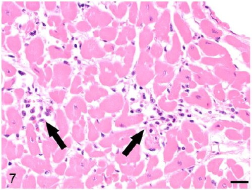 Figure 7. Case 2. The myocardium is infiltrated by lymphocytes, plasma cells and neutrophils (arrows). Bar = 20 µm.