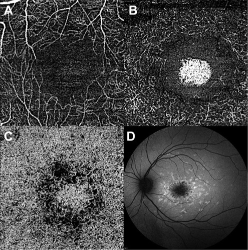 Figure 7 Optical coherence tomography angiography of STGD1. OCT angiography (left) shows foveal avascular zone enlargement and reduced vessel density on superficial capillary plexus (A) and deep capillary plexus (B), as well as damaged choriocapillaris (C). (D) Shows the corresponding autofluorescence.