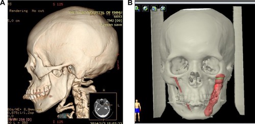 Figure 4 Images for preoperative analysis of the ESP and the virtual surgery plan.