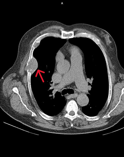 Figure 1 Thorax CT before treatment initiation. Intravenous contrast was administered prior to the exam. Extra pulmonary mass that infiltrates the thoracic cage and the ribs, as shown with the red arrow.