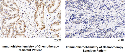 Figure 1 The expression of RUNX2 was detected by immunohistochemistry in 40 patients with gastric cancer. RUNX2 showing nuclear localization, the left image show representative image of the chemotherapy resistant group (magnification 200×), and the right image show representative image of the chemotherapy sensitive group (magnification 200×).