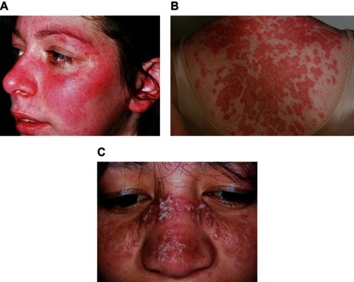 Figure 1 Acute cutaneous lupus erythematosus (A), subacute cutaneous lupus erythematosus (B), discoid lupus erythematosus (C).