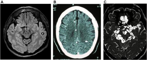 Figure 1 Parenchymal and extraparenchymal neurocysticercosis. (A) (left): Viable cyst showing its scolex (MRI, FLAIR protocol), (B) (center): calcified cysts (non-contrasted CT scan), and (C) (right): basal subarachnoid cysticercosis (MRI, BFFE protocol).