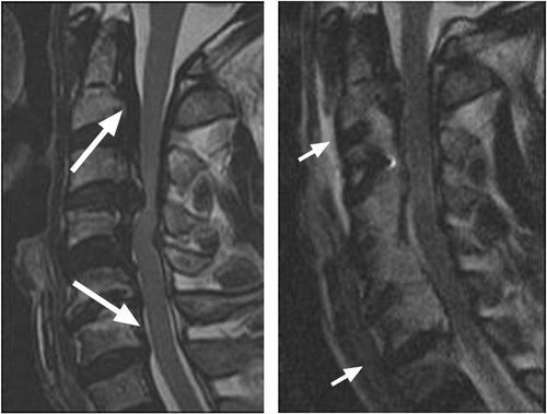 Figure 3. Preoperative and postoperative sagittal T2 images of a 62-year-old male with OPLL. Left: The upper and lower arrows indicate the direction of drilling. Right: The anterior portion of the upper and lower end segments was preserved.