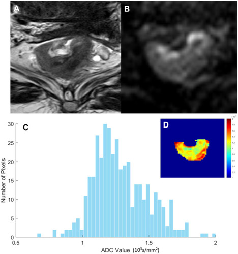 Figure 3 A51-year-old male patient with confirmed pT3N1 rectal cancer. (A) Maximum axial T2-weighted image showing irregular thickening of the rectal wall with intermediate signal intensity in the lower segment of the rectum. (B) The corresponding maximum axial diffusion-weighted (DW) image with the same lesion for delineation of regions of interest (ROIs). (C) Corresponding apparent diffusion coefficient (ADC) map histogram copying from ROI of DW image showing that the ADC mean of 1.29×103 s/mm2 and coefficient of variation of 0.163. (D) ADC pcolor map showing that the brighter the color, the greater the value.