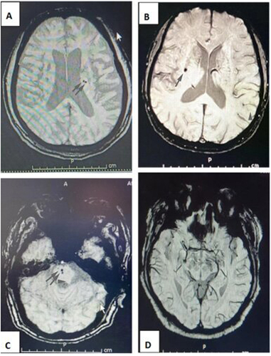 Figure 2 Distribution and characteristic of cerebral microbleed in three sub-groups of CMB group (a low-risk, medium-risk and high-risk group), and comparison with non-CMB group. (A) Distribution of CMB in the high-risk group. (B) Distribution of CMB in the medium-risk group. (C) Distribution of CMB in the low-risk group. (D) Distribution of cerebral bleed in non-CMB group.