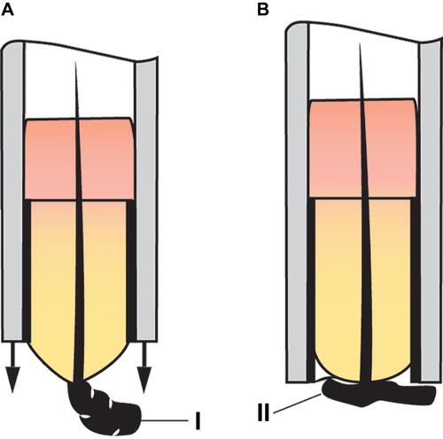 Figure 8 Patent application schematics demonstrating the crush injury phenomenon. (A) Friction impedes the follicle’s upward ascent, leading to the bulbar portion of the follicle – I to be crushed as the punch descends on it – II (B) Crush injury risk is minimized by the all-purpose punch’s texturing, which actively pulls the graft into the punch lumen. Impaction is further minimized by the punch’s spacious frustoconical design.