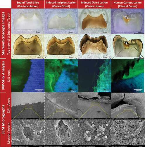 Figure 3. Characterization of the stages of induced ex-vivo caries lesion in comparison to the clinical caries lesion. The columns from left to right show the pre-inoculation stage, induced caries onset, induced overt caries lesion, and clinical caries lesion. The rows from top to bottom show the characterization methods with stereomicroscopy, multiphoton-second harmonic generation microscopy (MP-SHG) and scanning electron microscopy (SEM). The stereomicroscope images show the overall changes of the teeth specimens in reflection and transmission light modes. The specific dentin-enamel junction areas assigned for ultrastructural characterization are outlined with black dashed boxes. The MP-SHG examination shows the degradation of the enamel and dentin around the DEJ and spotted the early lesion in the mantle dentin zone, just beneath the DEJ. The SEM further characterized the ultrastructural changes of the mantle dentin associated with the ex-vivo caries induction compared to a clinical caries lesion. The micrographs showed the gradual degradation of the peritubular dentin and disorganization of the collagen fibers along the cariogenesis course; portraying the structural similarities between the induced overt lesions and clinical caries developed in the same dentin area.