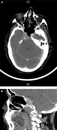 Figure 4 Case 2: (A) Axial and (B) sagittal views on computed tomography brain showing an infiltrative enhancing mass occupying the right cavernous sinus extending to the pituitary fossa and clivus.