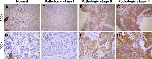 Figure 1 Immunohistochemical staining of CIP2A in NSCLC specimens.