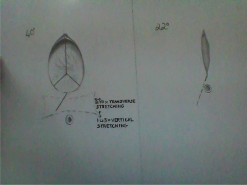 Figure 1 40 degree episiotomy at crowning resulting in a 22 degree post-delivery angle.