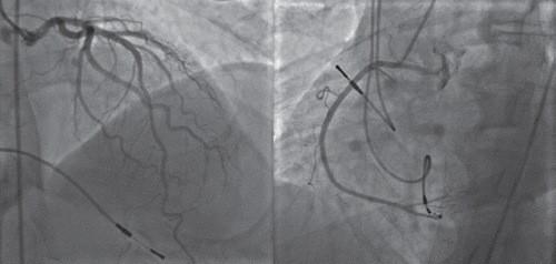 Figure 4. Coronary angiography without signs of coronary stenosis.