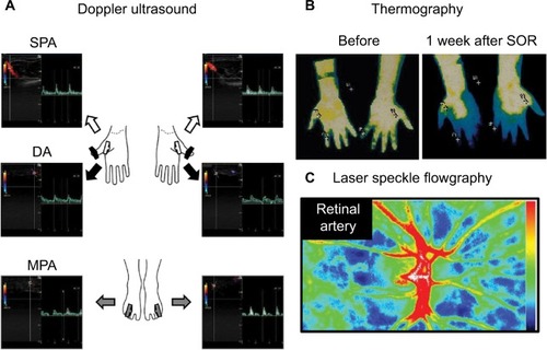 Figure 2 Blood flow analyses.Notes: (A) Doppler ultrasound for SPA, DA, and MPA. (B) Thermography before and after administration of SOR. (C) Laser speckle flowgraphy to measure the MBR.Abbreviations: SPA, superficial palmar arch; DA, digital artery; MPA, medial plantar artery; SOR, sorafenib; MBR, mean blur rate.