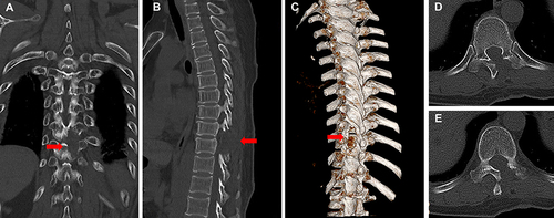 Figure 4 Computed tomography scan (CT) of post-operation. (A) Postoperative coronal CT of thoracic spine. (B) Postoperative sagittal postoperative CT. (C) Postoperative 3-dimensional CT. (D and E) Postoperative axial CT. Red arrow: the bone window.