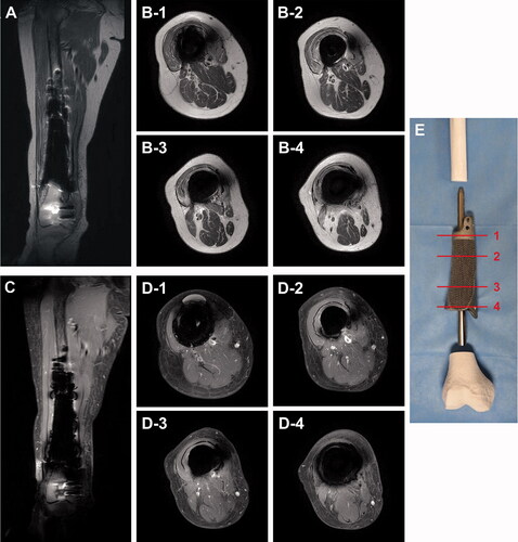 Figure 5. Metal artifacts in postoperative MR images. Metal artifacts around the titanium alloy (Ti6Al4V) megaprosthesis were not severe on postoperative MRI, and T2-weighted MR images (A, B) were clearer than enhanced T1-weighted MR images (C, D). Axial MR images were presented at the proximal solid cuff (B-1, D-1), proximal shaft with full lattice coating (B-2, D-2), distal shaft with anteromedial half-lattice coating (B-3, D-3), and distal solid cuff (B-4, D-4). (E) A photograph showing reference lines for axial images.