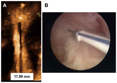 Figure 3 FibroPlant® levonorgestrel-releasing intrauterine system in situ.