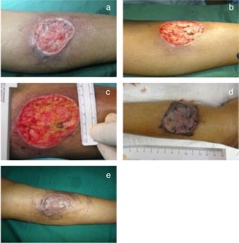 Fig. 3 Photographs of wound healing in Case Study 2. (a) Before debridement. (b,c) Post-operative day 1 and 7, respectively. (d,e) Post-SSG day 5 and week 8, respectively.