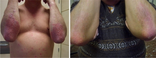Figure 4 Patient 1: reduction in erythema, desquamation and infiltration after the combined treatment with Oravex® and tacalcitol.