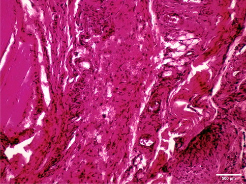 Figure 6. Intense inflammatory reaction and de novo formation of blood vessels one week after implantation of cold polymerized acrylate in m.biceps femoris of male Wistar rats. HE, ×100.