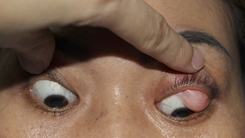 Figure 2 A yellowish subconjunctival mass is visible in the superior bulbar area of the globe.