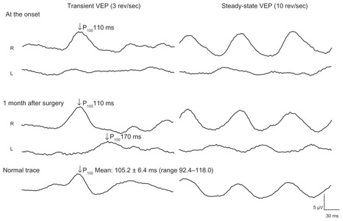 Figure 3 Pattern visual evoked potentials.