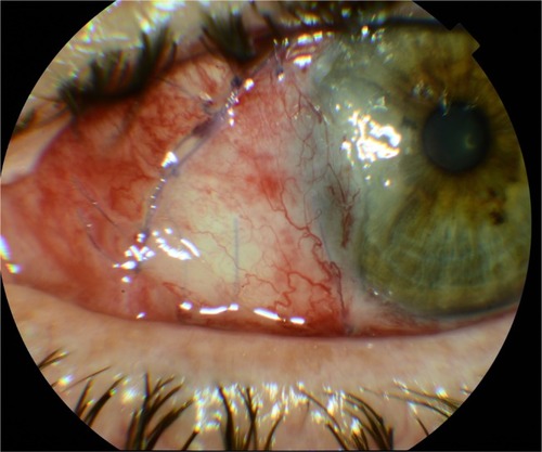 Figure 1 Postoperative results of a rotational flap, transposed from the inferior conjunctiva, with its vascular pedicle.