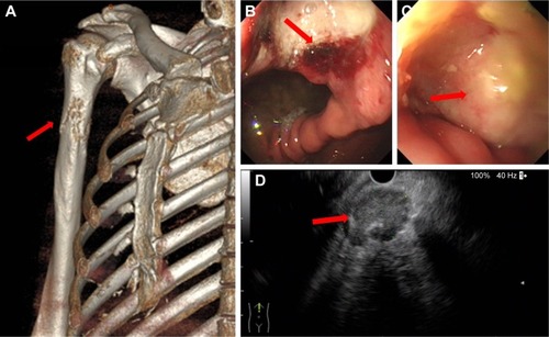 Figure 2 (A) Three-dimensional reconstruction of computed tomography image revealed that the right upper humeral bone metastasis was combined with a pathological bone fracture (arrow). (B) Gastroscopy revealed an ulcer (arrow) of approximately 2×2 cm located in posterior wall of gastric corpus. (C) A rough uplift (arrow) of 1.5×2.0 cm was observed in the junction of duodenal bulb and descending part. (D) Endoscopic ultrasound-guided fine needle aspirate was performed on mediastinal lymph nodes (arrow).