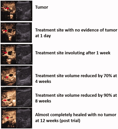 Figure 3. Involution of treatment zone. Tumor and treatment zone (red arrow) at each time point on contrast-enhanced ultrasound.