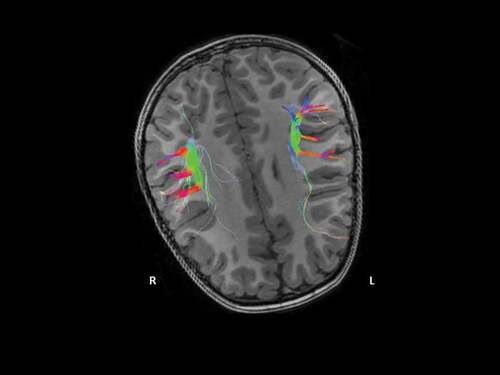 Figure 1. Color orientation 3D-tractography reconstruction of the arcuate fascicle. The patent´s right-left asymmetry evidence a shorter tract and a lower amount of nerve fibers on the left side.