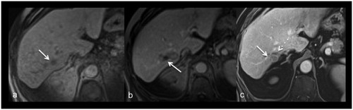 Figure 3. Images of a 77-year-old female with metastasis of a melanoma. Planning imaging (a) depicts the small metastasis (17 mm) in segment VII (arrow). Post-procedural imaging (b) depicts an ablation zone with an almost non-visible safety margin dorso-medial (arrow). After 40 months local recurrence (arrow) was diagnosed on routine contrast-enhanced follow-up imaging (c) dorsal to the shrunken ablation zone (dash arrow).