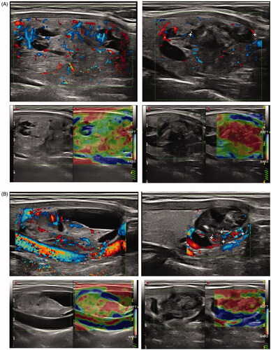 Figure 3. (A) Example of incomplete ablation in longitudinal plane. Left part of picture shows nodule before treatment (upper picture: color Doppler, lower picture: strain elastography) with moderate central vascularity and low heterogeneous stiffness. The right part of the picture shows the same nodule after treatment (same techniques). The upper and inferior part of the nodule has turned hypoechoic, avascular and with high stiffness, corresponding to the ablated volume, representing only a fraction of the remaining volume. (B) Example of nearly complete ablation in longitudinal plane. Left part of picture shows nodule before treatment (upper picture: color Doppler, lower picture: strain elastography) with moderate central vascularity and low heterogeneous stiffness. The right part of the picture shows the same nodule after treatment (same techniques). Nearly the entire nodule has turned hypoechoic, avascular and with high stiffness, corresponding to the ablated volume, representing the main fraction of the remaining volume.