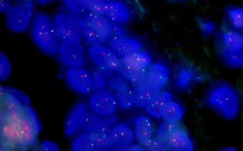 Figure 4 Fluorescence in situ hybridization demonstrated the gene rearrangement of NUTM1. Large proportion cells showing 1 red 1 green 1 fusion signal, indicating NUTM1 fused with partner genes.