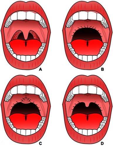 Figure 1 (A) A pre-surgical laser-assisted uvulopalatoplasty or uvulopalatopharyngoplasty candidate. (B) Traditional uvulopalatopharyngoplasty which shows the large, continuous surgical site. (C) Modified uvulopalatopharyngoplasty which shows plication of the uvula upward to the soft palate and reduces the risk of velopharyngeal stenosis or insufficiency. (D) Tissue-sparing approach of palatopharyngoplasty with only a partial resection of the uvula, which likely results in even fewer complications. (This figure is an open source image made available in Wikimedia Commons, which allows anyone the right to use this image based on the Creative Commons ShareAlike 4.0 license).