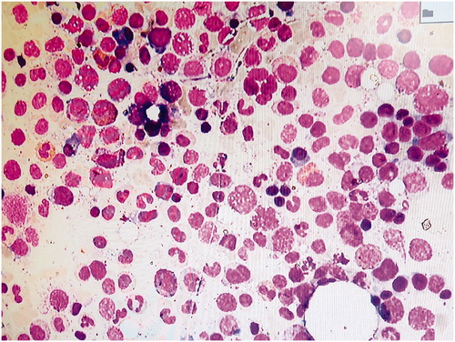 Figure 6. High-power appearance of the spread bone marrow aspirate showing normal bone particles of bone marrow at the end of cellular trails.