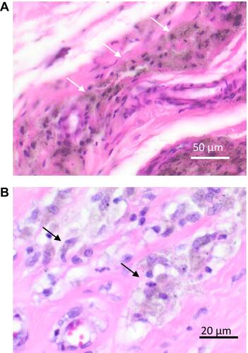 Figure 1 (A and B) Histopathology revealed high amounts of wear particles (white arrows) around the implant. Also, a high number of predominately mononuclear cells (black arrows) were detected.