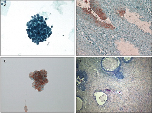 Figure 3. Liquid-based cervical cytology demonstrating atypical cellular clusters (A, B) positive for chromogranin A (B) (original magnification 400×). Histological preparation of the cervix revealing poorly differentiated small cell neuroendocrine tumor involving the cervical crypts (C, D), positive for chromogranin A (C) (original magnification 400×).