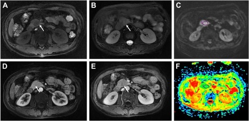 Figure 3 A 48-year-old male with a pathologically proven, grade 2 neuroendocrine tumor in the pancreatic tail.