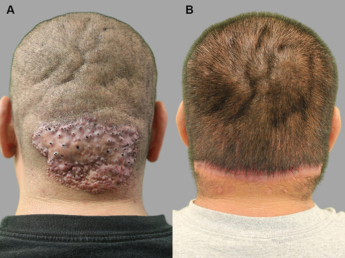 Figure 5 CVG and localized AKN plaque confined to the nape area: patient 4 — with CVG that preceded the onset of AKN lesions by two decades: posterior view of the head, showing a single AKN plaque confined to the nuchal area and CVG folds in the crown and vertex (A) and after complete excision of AKN plaque (B).