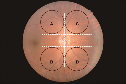 Figure 2 Schematic diagram of the 4 areas selected for analysis of right eye. (A) superior temporal, (B) inferior temporal, (C) superior nasal, (D) under nasal.