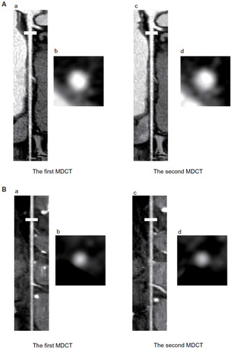 Figure 2 Representative stretched multiplanar reconstruction images of the coronary artery and left internal thoracic artery determined by MDCT examinations.