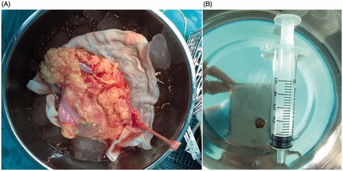 Figure 2. (A) The extracted donor kidney. (B) A 4 mm intact renal calculi removed from a donor kidney.