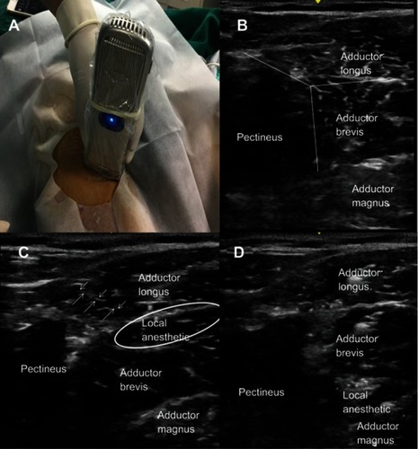 Figure 1 Ultrasound-guided distal obturator nerve block. (A) Patient is in supine position with the thigh slightly abducted and externally rotated. The transducer is placed perpendicularly just below the inguinal ligament. (B) The pectineus, adductor longus, adductor brevis, and adductor magnus muscles are identified and Y shape is visualized. (C) A needle is in an advanced lateral-to-medial direction using in-plane ultrasound guidance until the needle tip is positioned at fascial interface between the adductor longus and adductor brevis muscles, then local anesthetic is injected. (D) Local anesthetic is injected between adductor brevis muscles and adductor magnus.