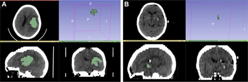 Figure 1 Calculation and analysis of the hematoma volumes and hematoma evacuation rates in the neuroendoscopic surgery patients with the 3D Slice software.