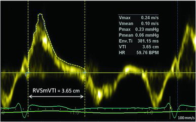 Figure 1. Tracing (dotted line) of right ventricular velocity time integral (RVSmVTI) from tissue Doppler obtained from the lateral tricuspid annulus.